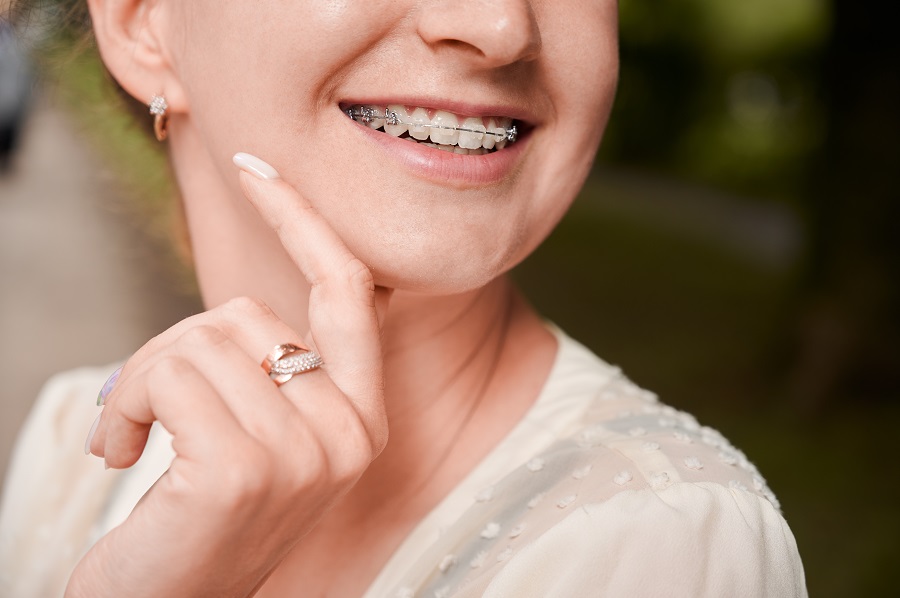 How to Get a Good Deal on Braces Under 00