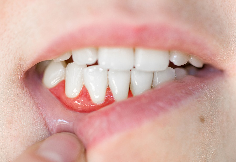 The Correlation Between Diabetes and Gum Disease