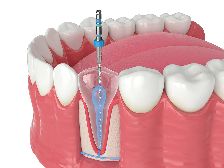 Endodontic Therapy: A Comprehensive Guide to Saving Your Tooth in Palm Coast, FL