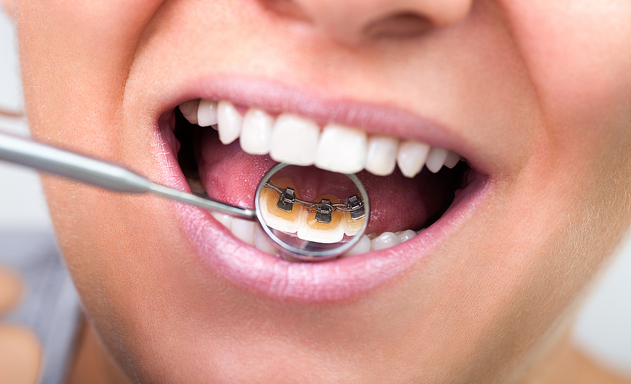 The Benefits of Endodontic Therapy: Why Saving Your Tooth is Worth It